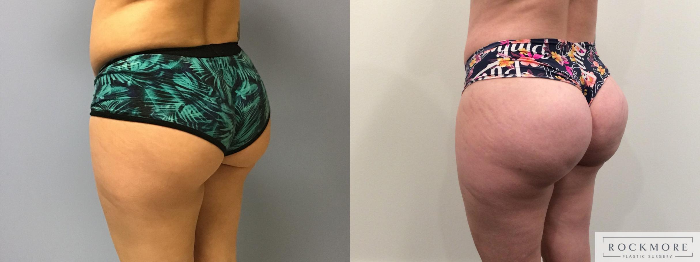 Before & After Brazilian Butt Lift Case 375 Right Oblique View in Albany & Latham, New York