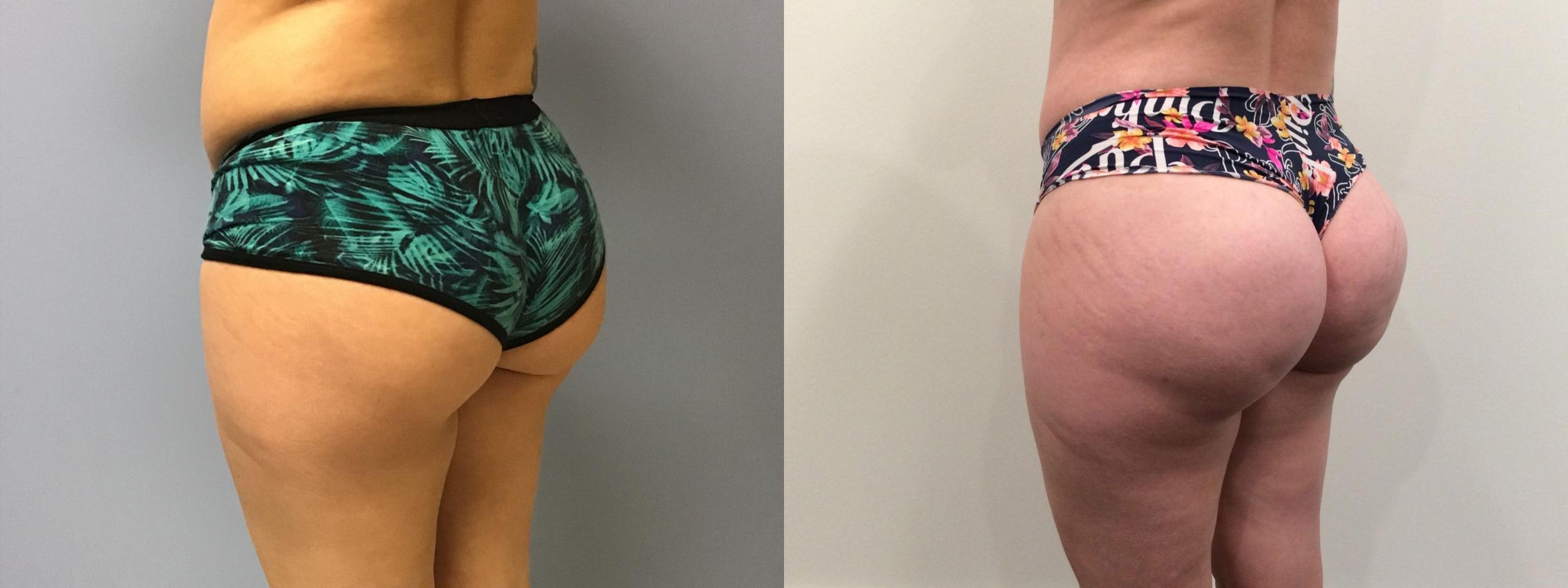 brazilian butt lift workout after three months