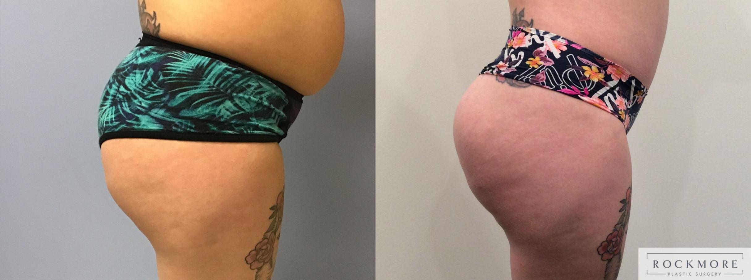 Before & After Brazilian Butt Lift Case 375 Right Side View in Albany & Latham, New York
