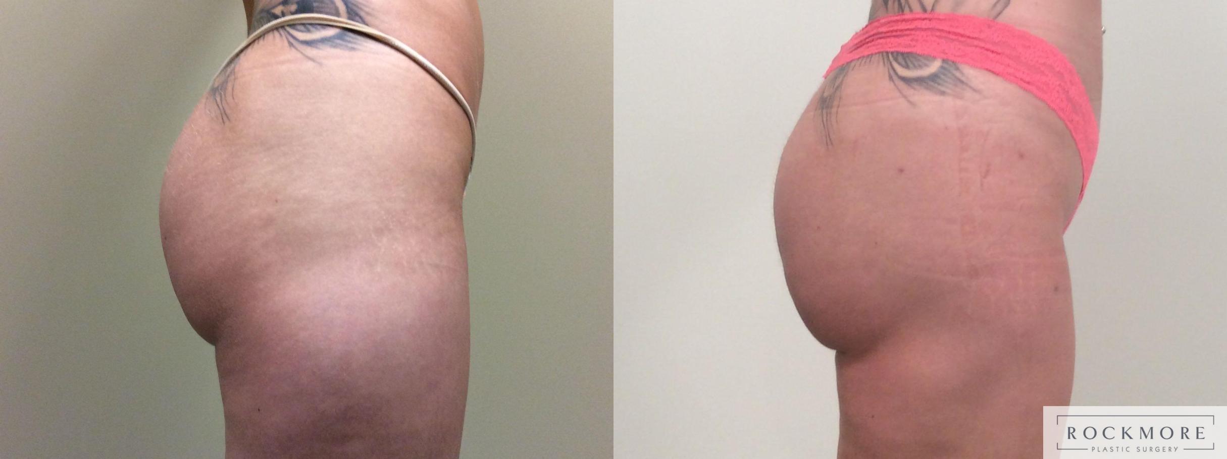 Before & After Brazilian Butt Lift Case 380 Right Side View in Albany & Latham, New York