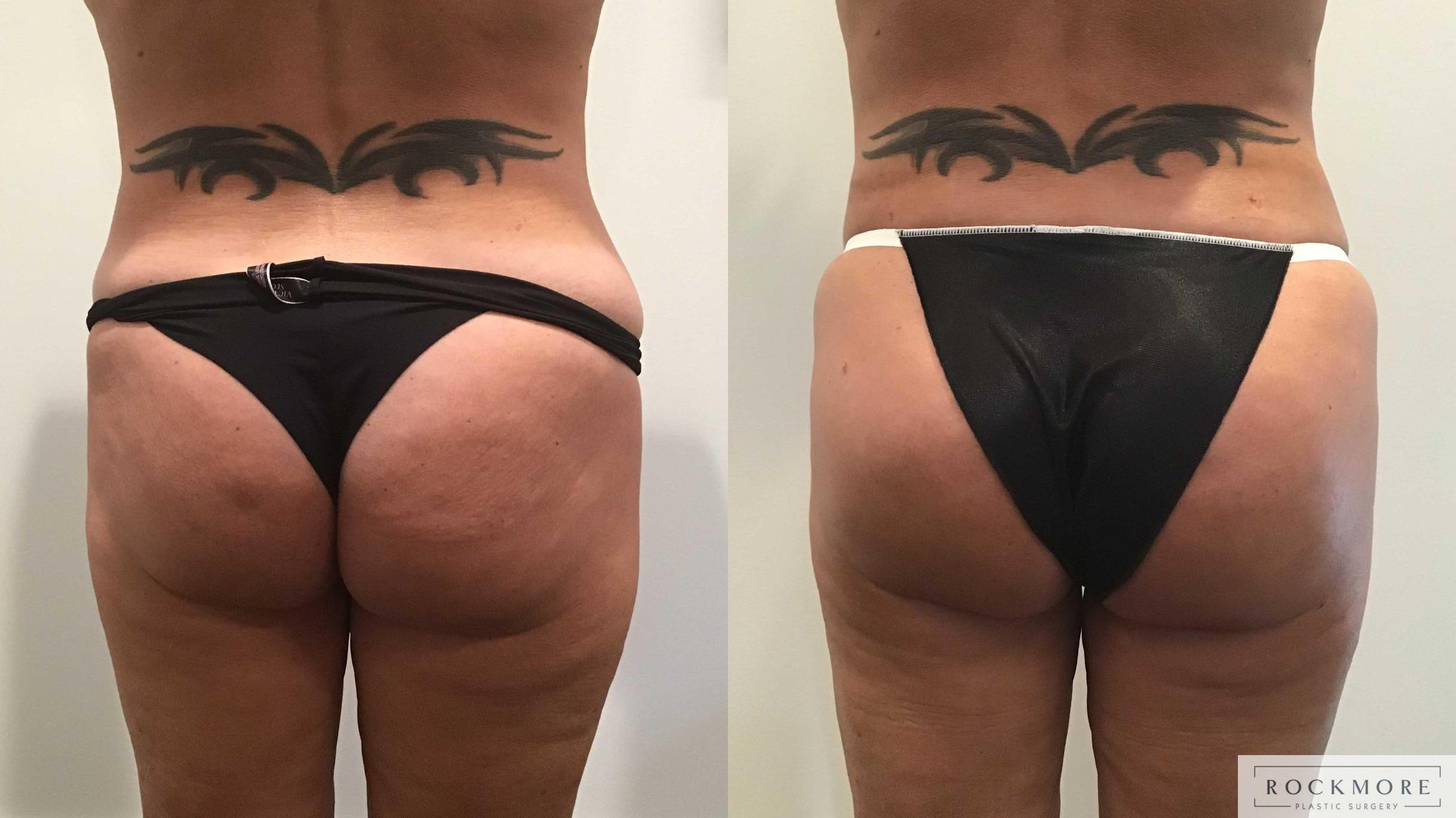 Before & After Brazilian Butt Lift Case 412 Front View in Albany & Latham, New York