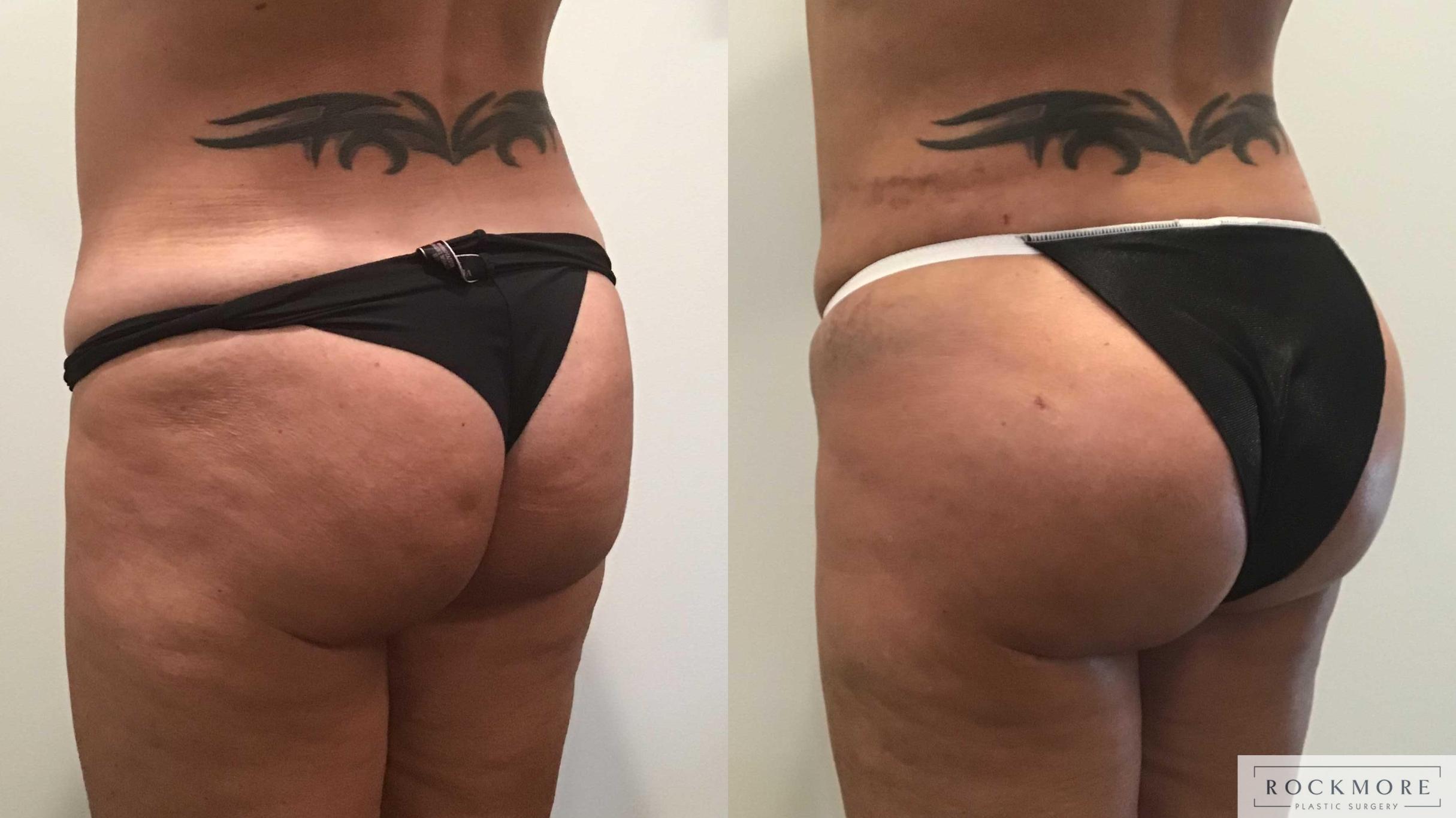 Before & After Brazilian Butt Lift Case 412 Left Side View in Albany & Latham, New York