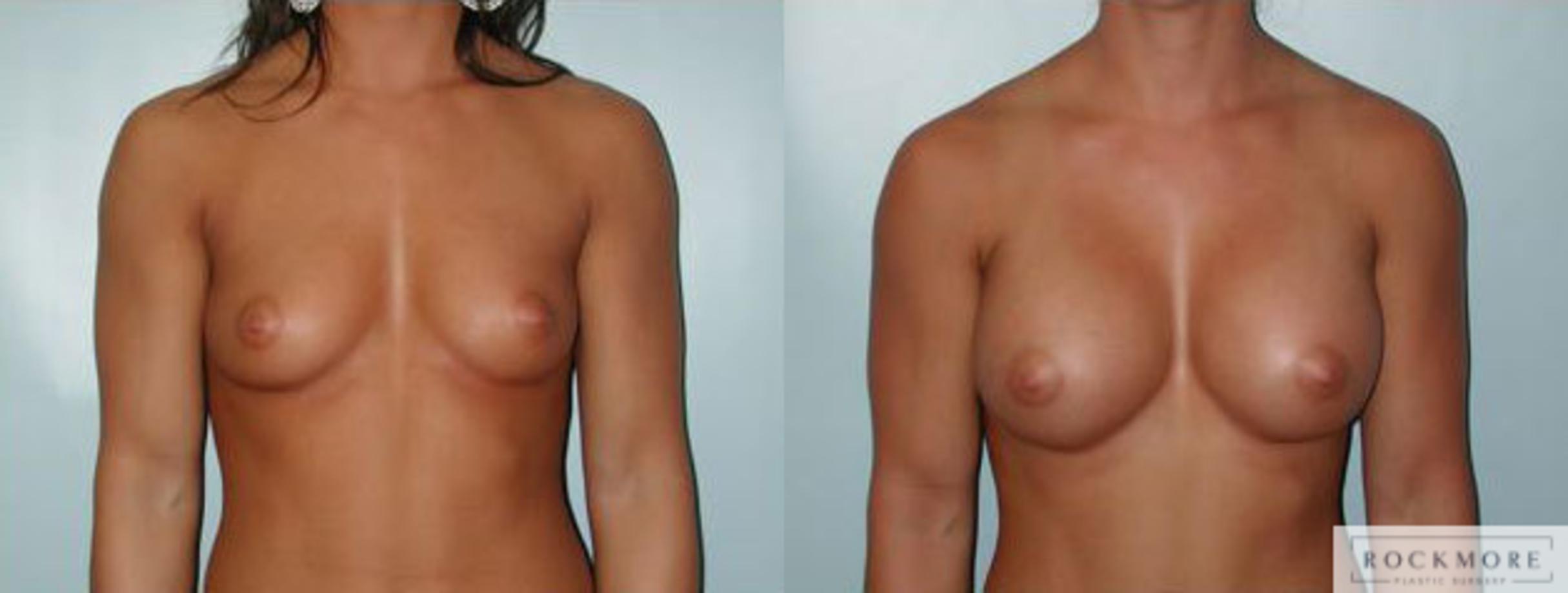 Before & After Breast Augmentation Case 104 View #1 View in Albany & Latham, New York