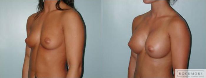 Before & After Breast Augmentation Case 104 View #2 View in Albany & Latham, New York