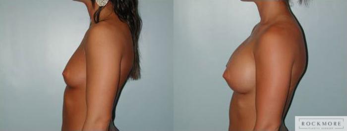 Before & After Breast Augmentation Case 104 View #3 View in Albany & Latham, New York