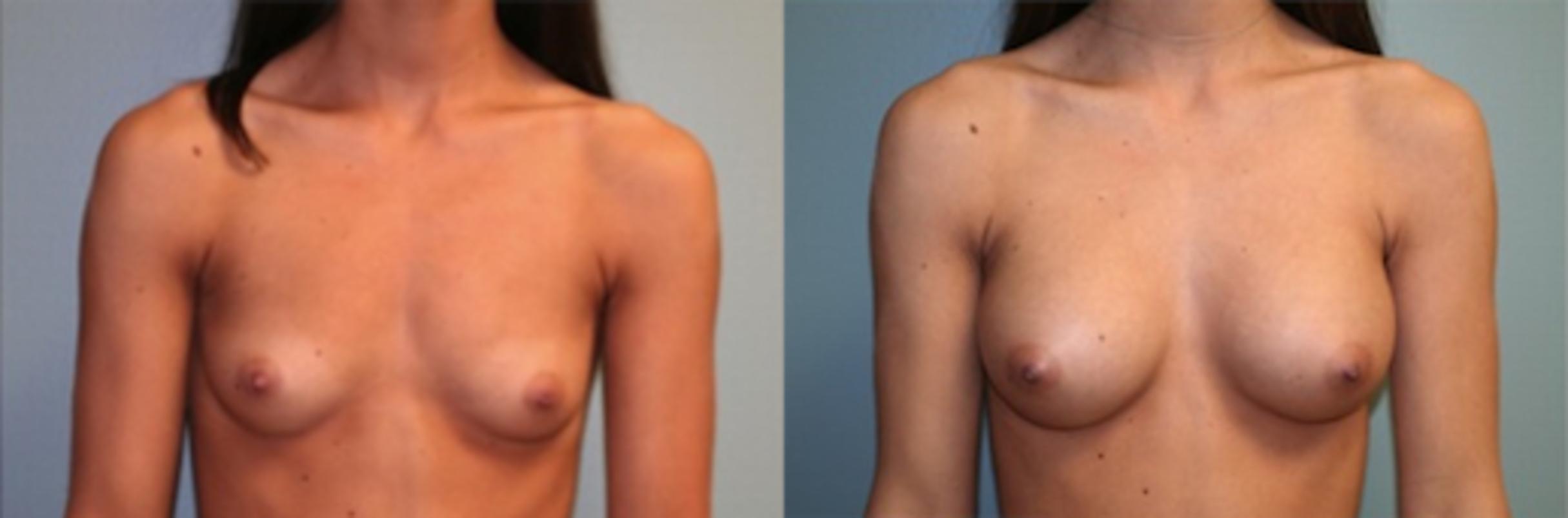 Before & After Breast Augmentation Case 125 View #1 View in Albany & Latham, New York