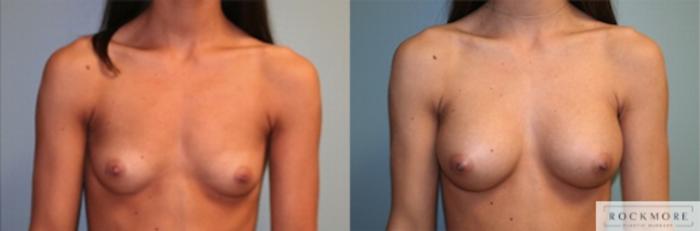 Before & After Breast Augmentation Case 125 View #1 View in Albany & Latham, New York