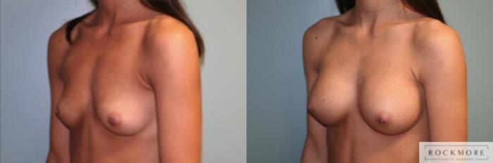 Before & After Breast Augmentation Case 125 View #2 View in Albany & Latham, New York