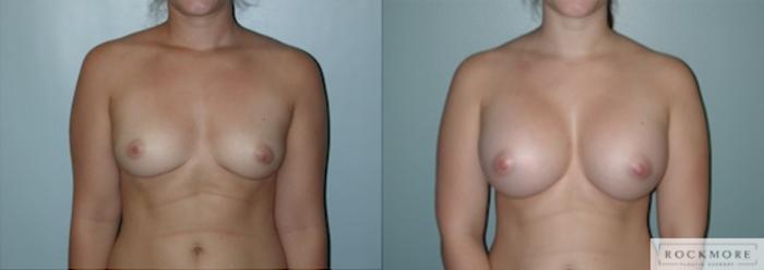 Before & After Breast Augmentation Case 129 View #1 View in Albany & Latham, New York
