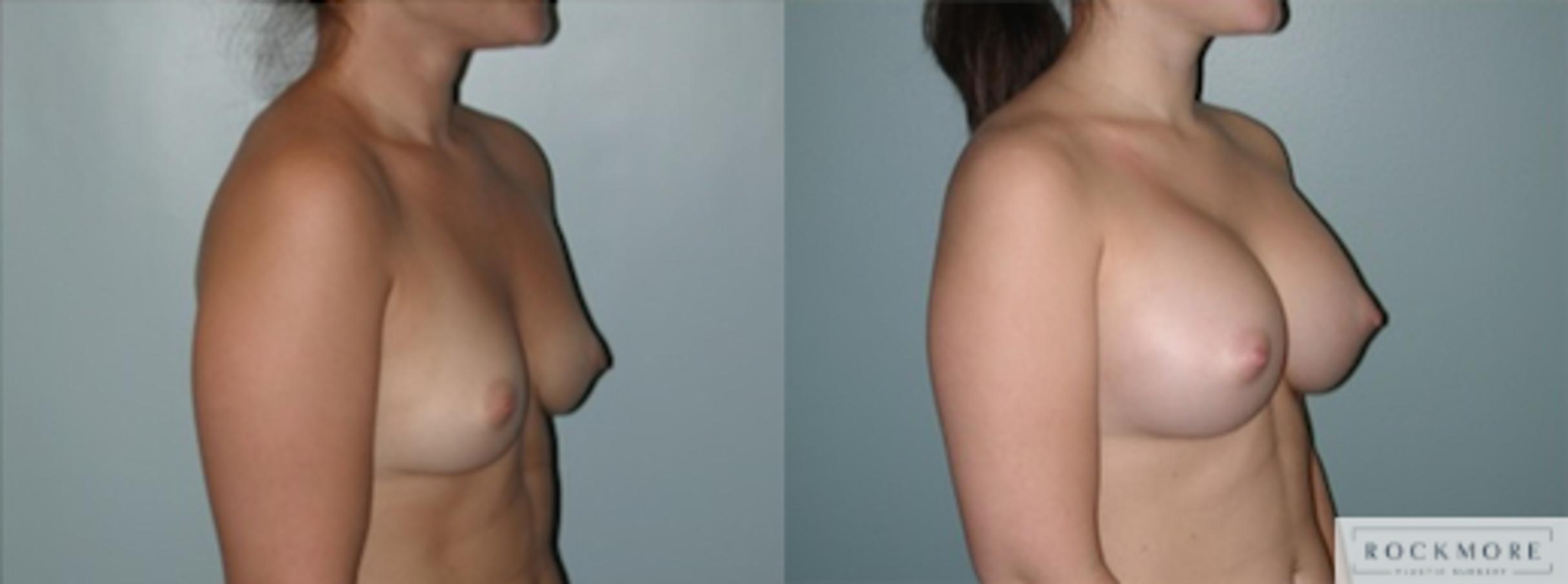 Before & After Breast Augmentation Case 129 View #2 View in Albany & Latham, New York