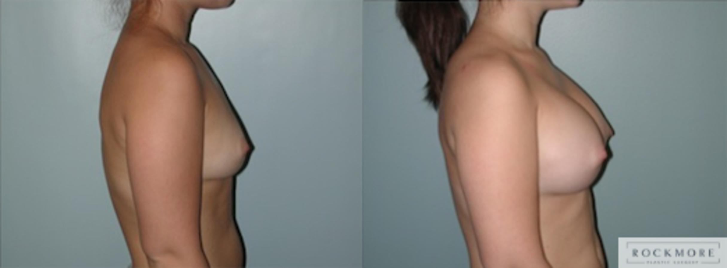 Before & After Breast Augmentation Case 129 View #3 View in Albany & Latham, New York