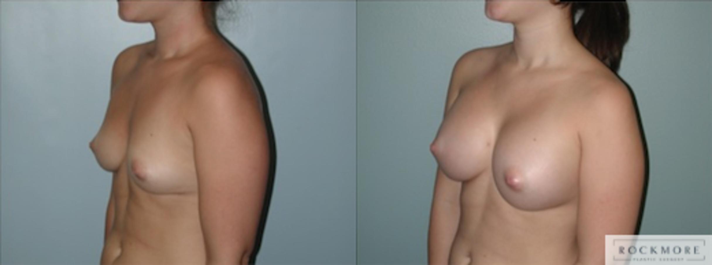 Before & After Breast Augmentation Case 129 View #4 View in Albany & Latham, New York