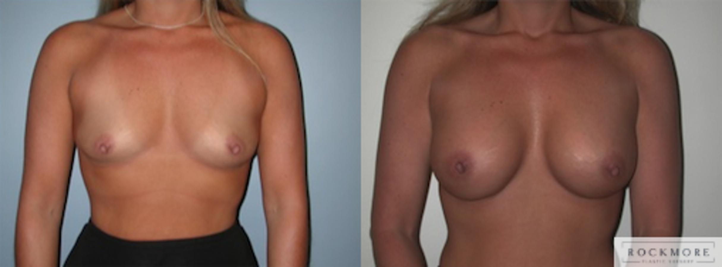 Before & After Breast Augmentation Case 132 View #1 View in Albany & Latham, New York