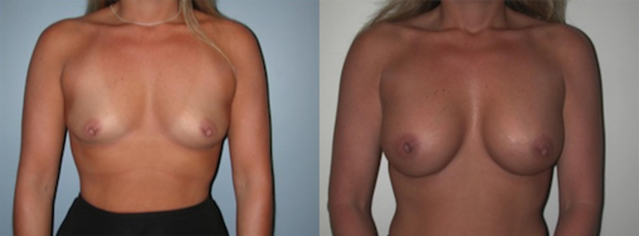 Before & After Breast Augmentation Case 132 View #1 View in Albany & Latham, New York