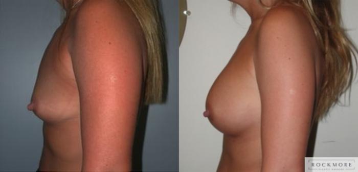 Before & After Breast Augmentation Case 132 View #3 View in Albany & Latham, New York