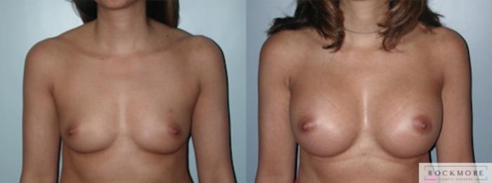 Before & After Breast Augmentation Case 134 View #1 View in Albany & Latham, New York