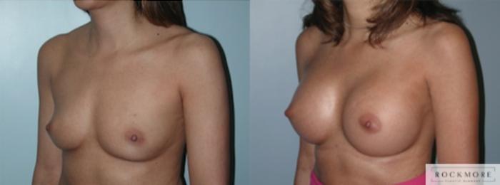 Before & After Breast Augmentation Case 134 View #2 View in Albany & Latham, New York