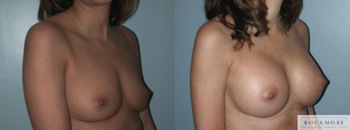Before & After Breast Augmentation Case 134 View #3 View in Albany & Latham, New York