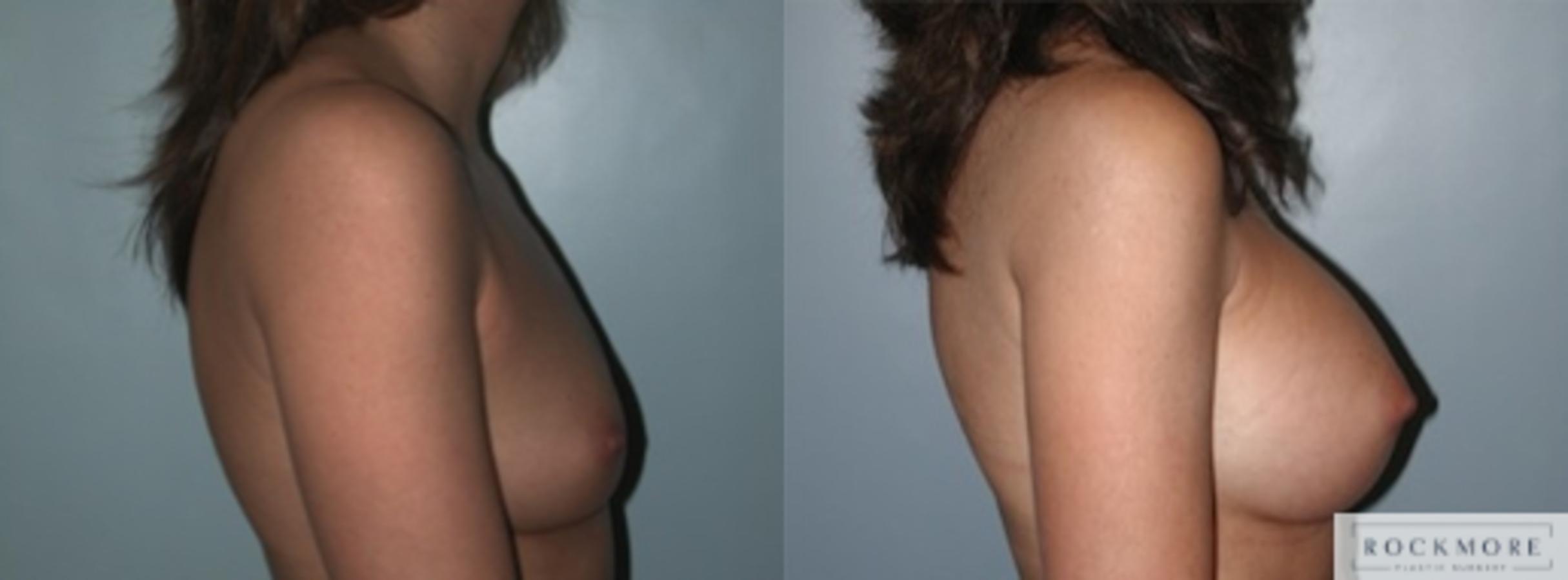 Before & After Breast Augmentation Case 134 View #4 View in Albany & Latham, New York