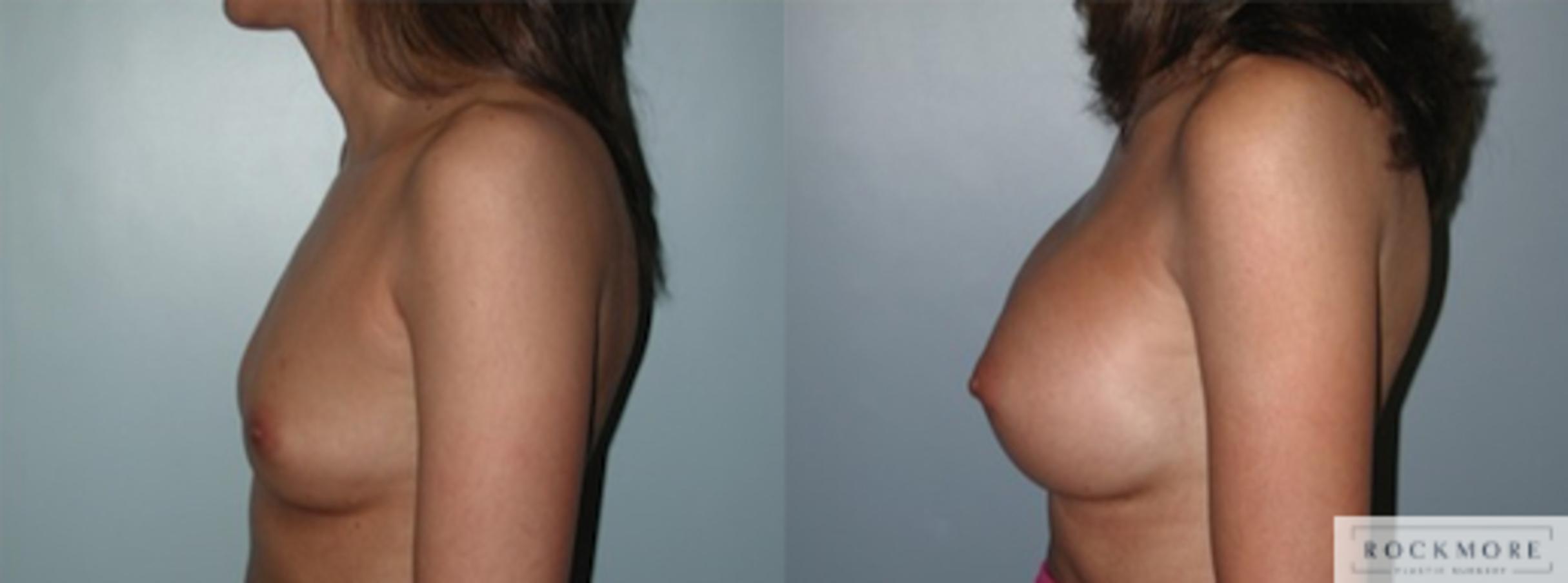Before & After Breast Augmentation Case 134 View #5 View in Albany & Latham, New York
