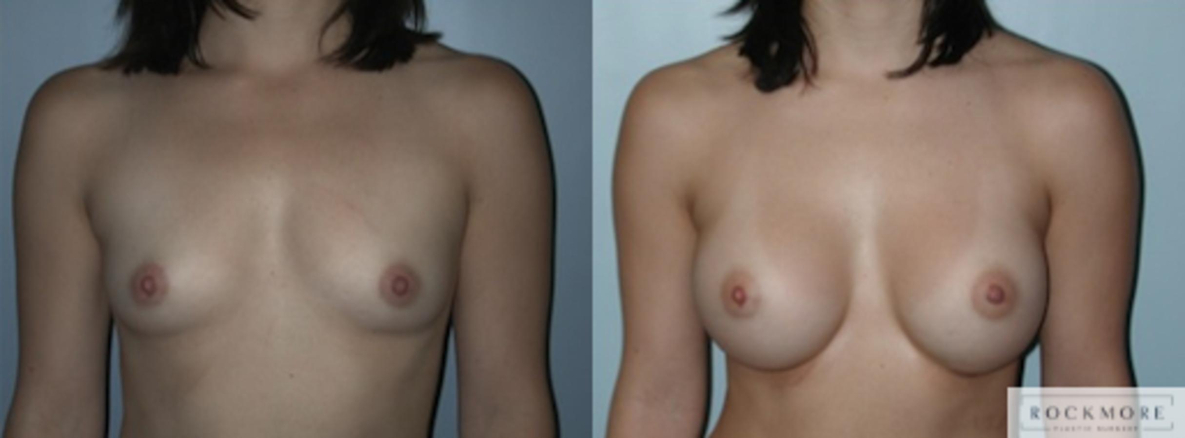 Before & After Breast Augmentation Case 135 View #1 View in Albany & Latham, New York