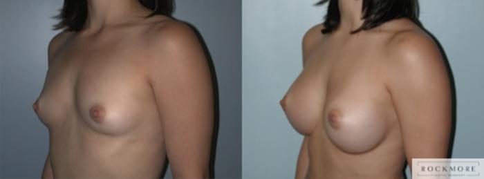 Before & After Breast Augmentation Case 135 View #2 View in Albany & Latham, New York