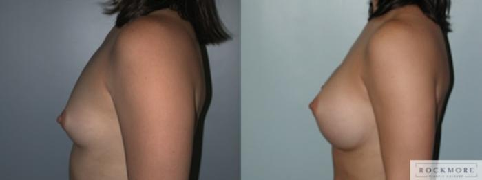 Before & After Breast Augmentation Case 135 View #3 View in Albany & Latham, New York