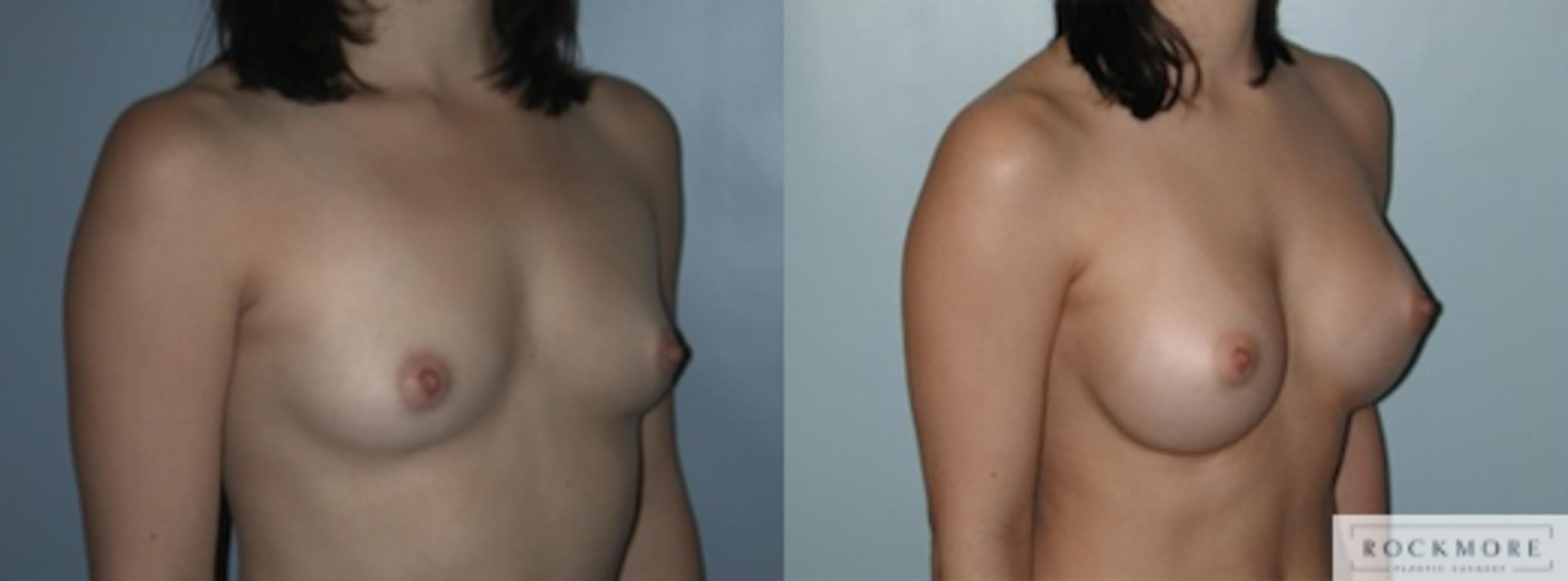 Before & After Breast Augmentation Case 135 View #4 View in Albany & Latham, New York
