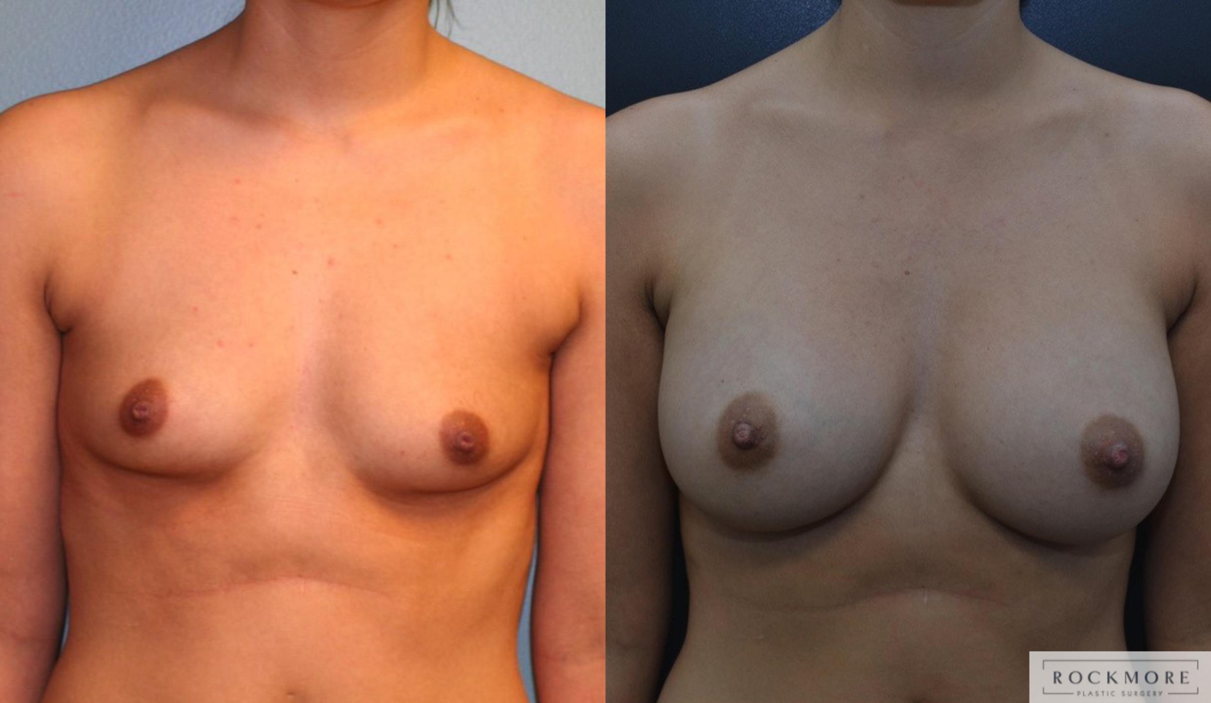 Before & After Breast Augmentation Case 164 View #1 View in Albany & Latham, New York