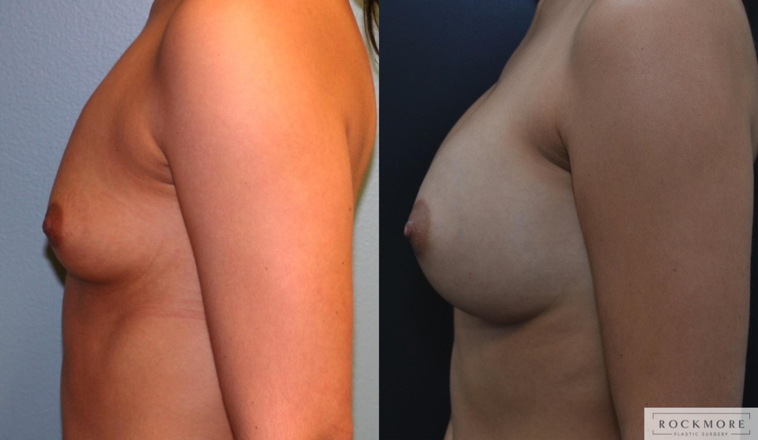 Before & After Breast Augmentation Case 164 View #2 View in Albany & Latham, New York