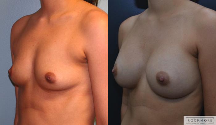 Before & After Breast Augmentation Case 164 View #3 View in Albany & Latham, New York