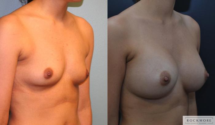 Before & After Breast Augmentation Case 164 View #4 View in Albany & Latham, New York
