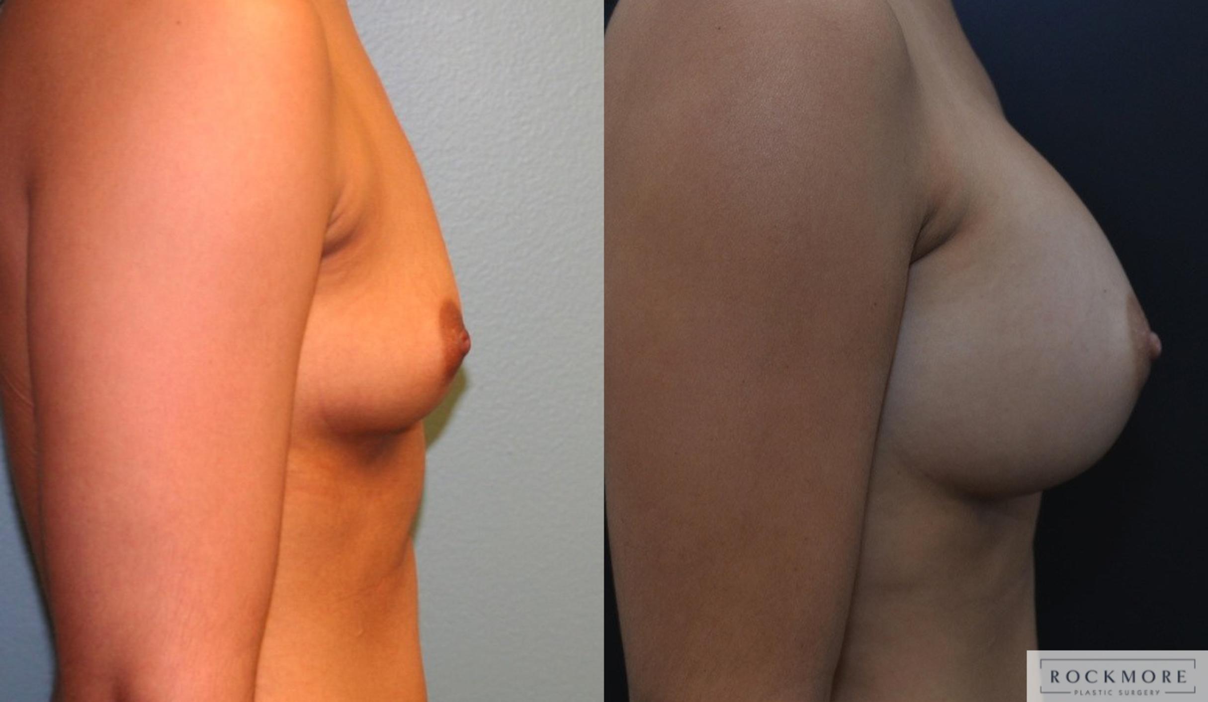 Before & After Breast Augmentation Case 164 View #5 View in Albany & Latham, New York