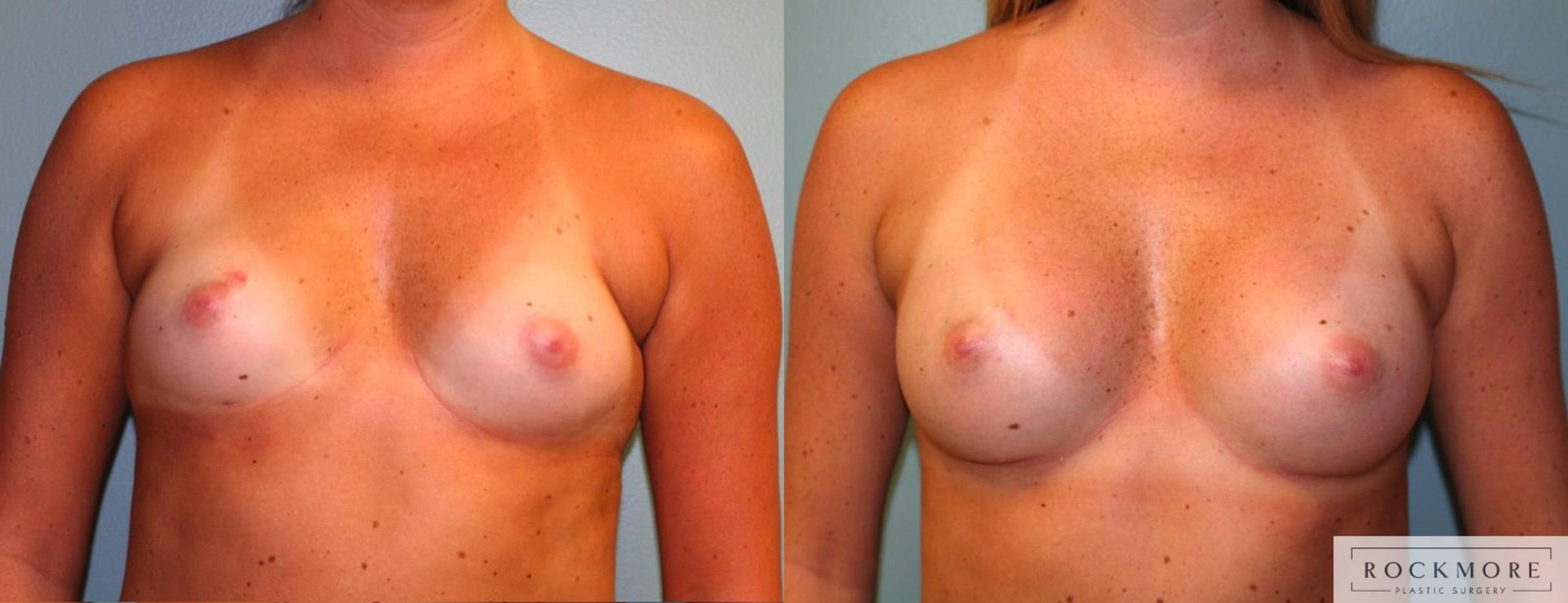 Before & After Breast Augmentation Case 167 View #1 View in Albany & Latham, New York
