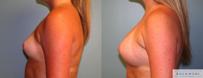 Before & After Breast Augmentation Case 167 View #2 View in Albany & Latham, New York
