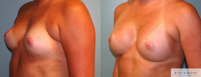 Before & After Breast Augmentation Case 167 View #3 View in Albany & Latham, New York