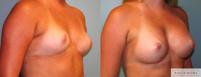 Before & After Breast Augmentation Case 167 View #4 View in Albany & Latham, New York