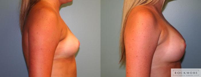 Before & After Breast Augmentation Case 167 View #5 View in Albany & Latham, New York