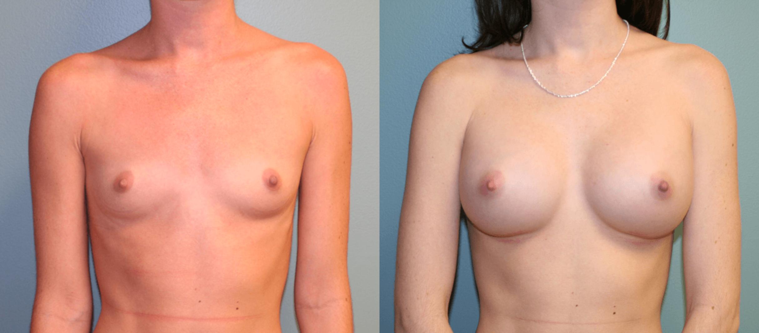 Before & After Breast Augmentation Case 168 View #1 View in Albany & Latham, New York