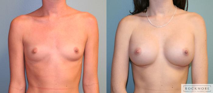 Before & After Breast Augmentation Case 168 View #1 View in Albany & Latham, New York