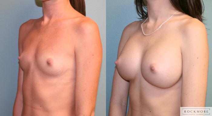 Before & After Breast Augmentation Case 168 View #2 View in Albany, Latham & Saratoga, New York