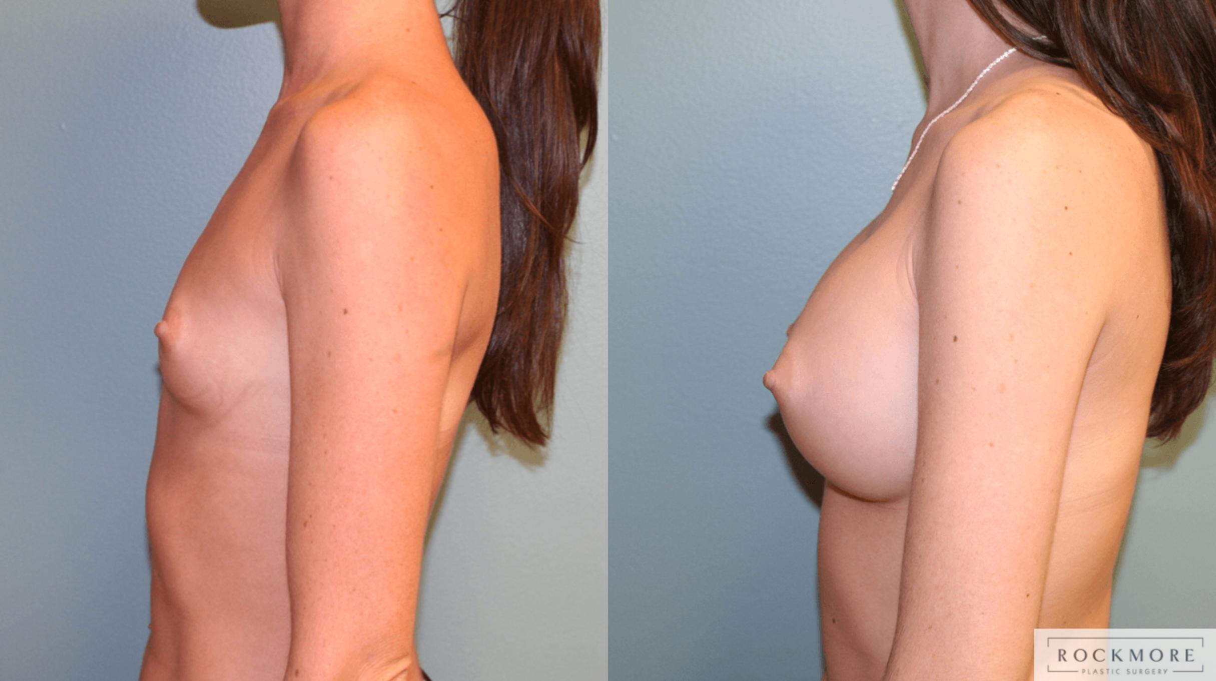 Before & After Breast Augmentation Case 168 View #3 View in Albany & Latham, New York