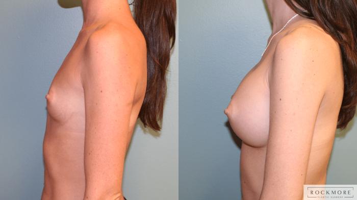 Before & After Breast Augmentation Case 168 View #3 View in Albany, Latham & Saratoga, New York