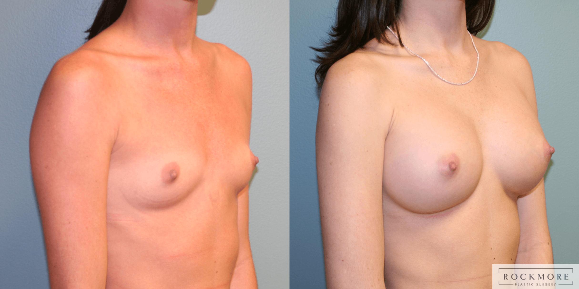 Before & After Breast Augmentation Case 168 View #4 View in Albany & Latham, New York
