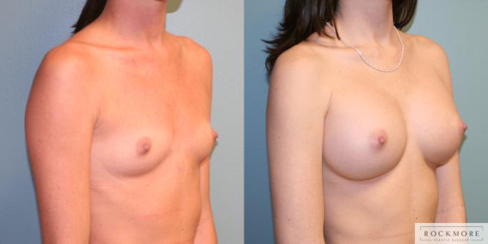 Before & After Breast Augmentation Case 168 View #4 View in Albany, Latham & Saratoga, New York