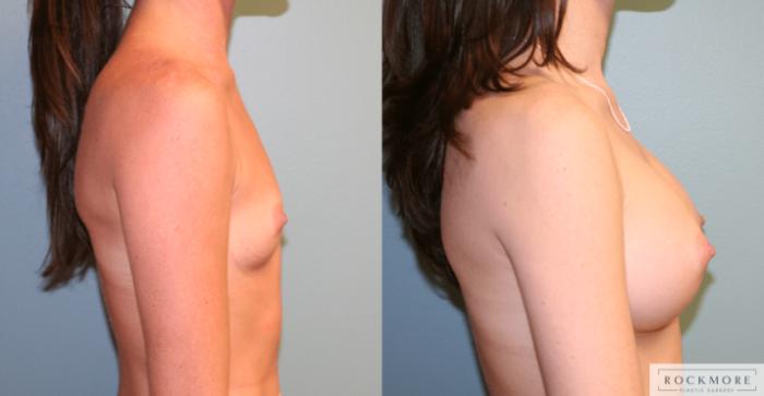 Before & After Breast Augmentation Case 168 View #5 View in Albany, Latham & Saratoga, New York