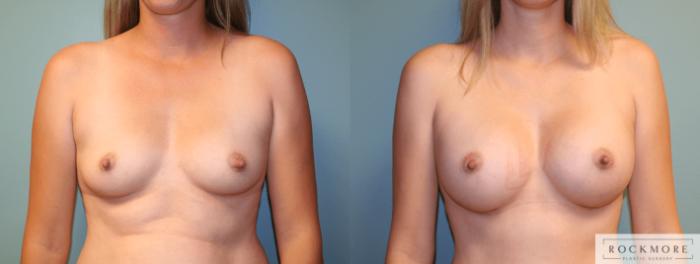 Before & After Breast Augmentation Case 171 View #1 View in Albany & Latham, New York