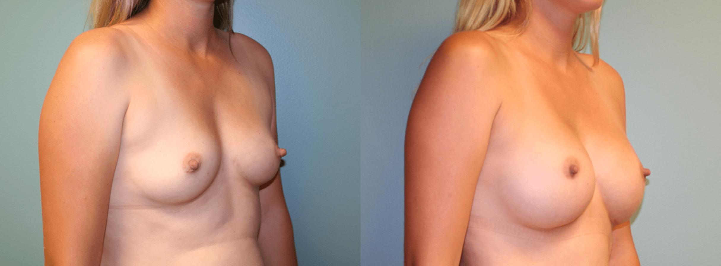 Before & After Breast Augmentation Case 171 View #2 View in Albany, Latham & Saratoga, New York