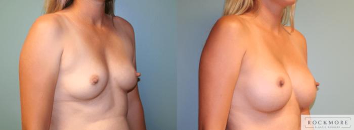 Before & After Breast Augmentation Case 171 View #2 View in Albany & Latham, New York