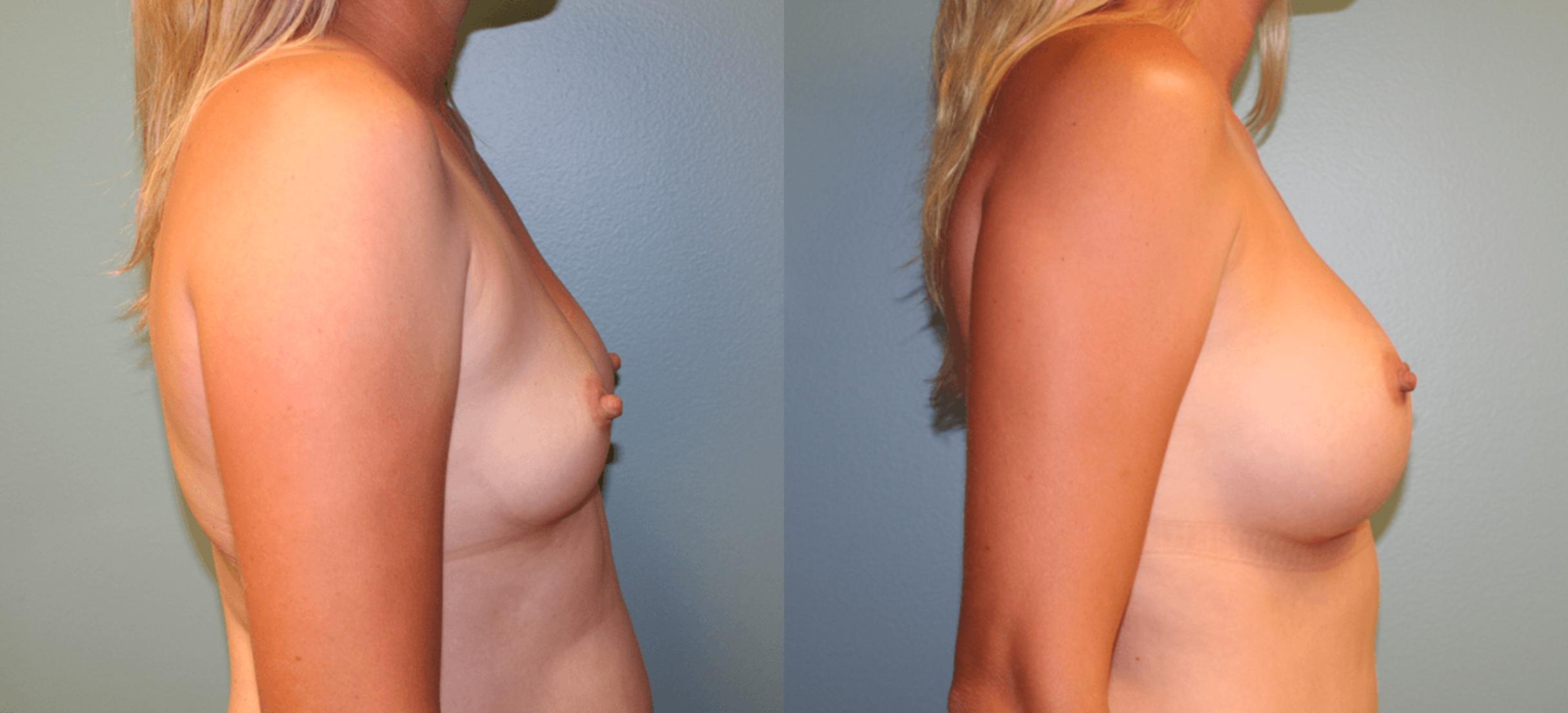 Before & After Breast Augmentation Case 171 View #3 View in Albany, Latham & Saratoga, New York